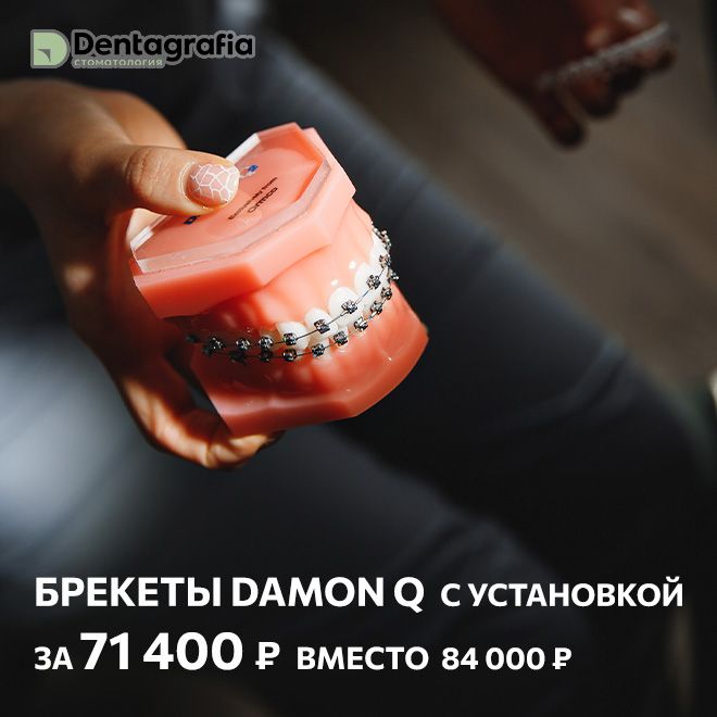 Брекет-Система Damon Q с устаовкой